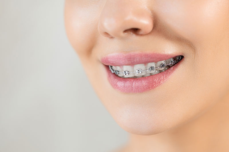 Braces in Dallas