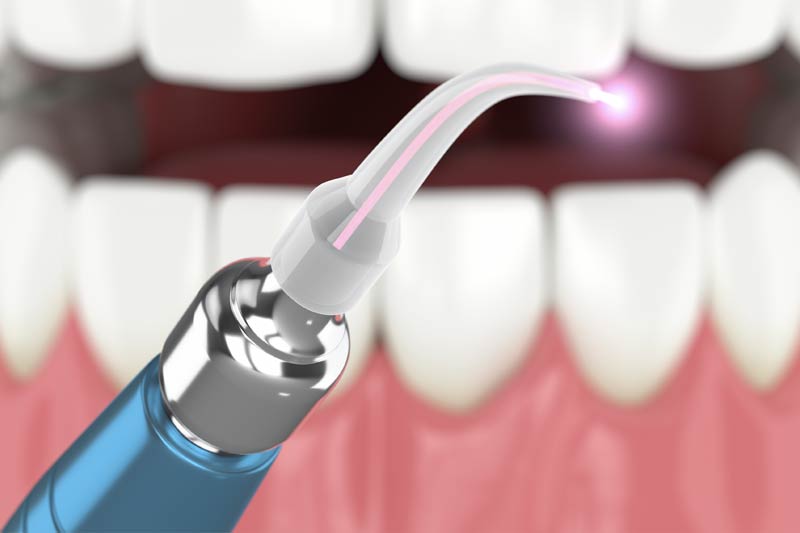 Laser Dentistry in Dallas