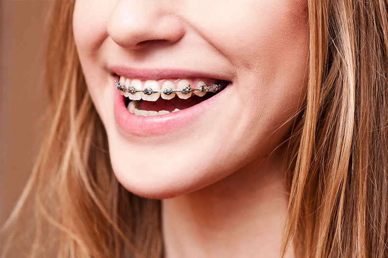 Orthodontics in Dallas