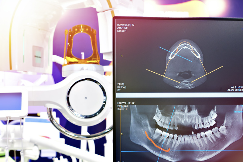 Digital X-Rays in Dallas